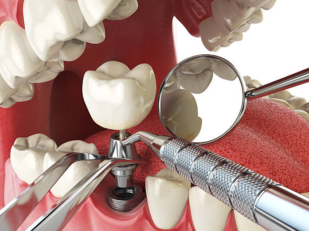 Best Emergency Dental Extractions in Poplar Bluff, MO